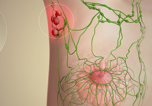 Wat gebeurt er als kanker zich verspreidt naar de lymfeklieren?